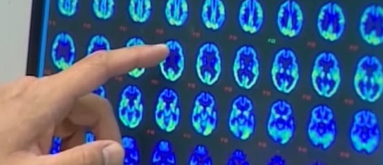 Healthier Hawaii: Warning signs of dementia, tips for healthy aging brains